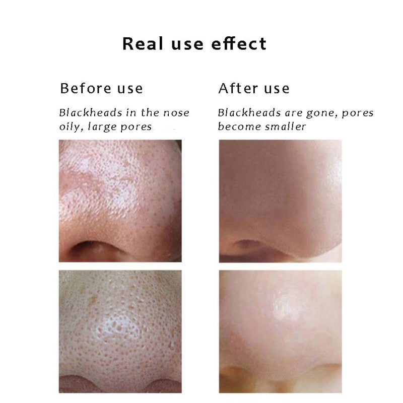 Professional Blackhead Remover Vacuum Acne Pimple Black Spot Suction
